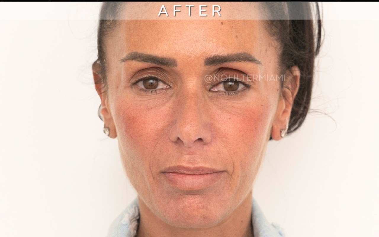 No Filter Medical Spa patient result, after treatment
