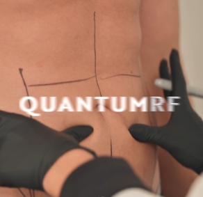Quantum RF at No Filter Medical Spa